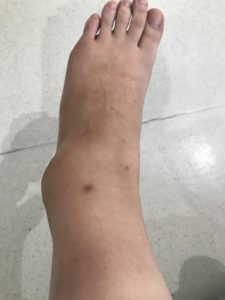 Swollen ankle2