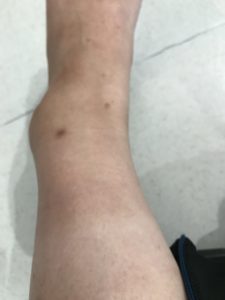 Swollen ankle3