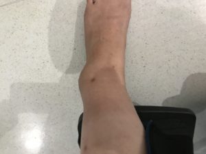 Swollen ankle4